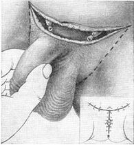 Surgery lengthens the penis by pulling out its hidden part