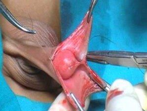 Surgery to increase male penis size